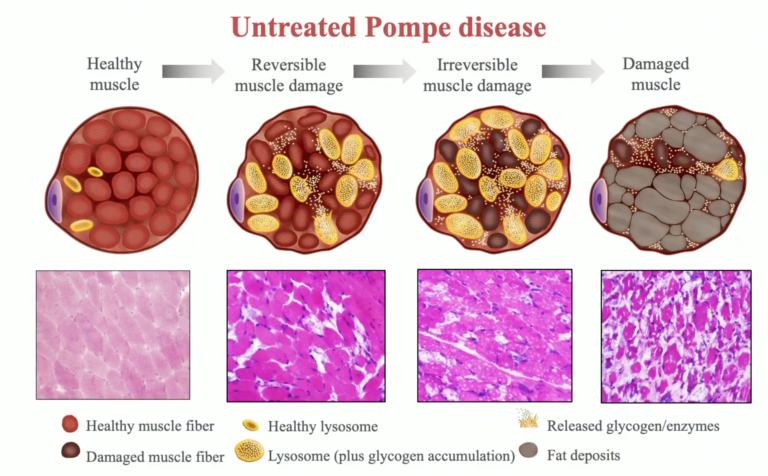 about-pompe-disease-savechloe